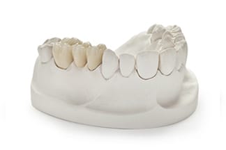White Hi-Noble PFM Porcelain Fused Metal Dental Crowns & Bridges