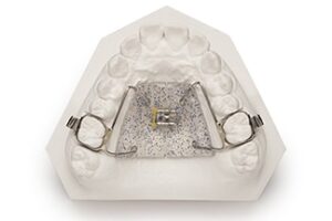 Haas Palatal Expander Dental Lab | DDS Lab